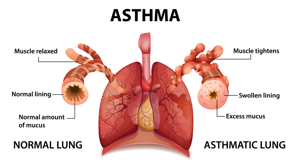 ayurvedic treatment for asthma